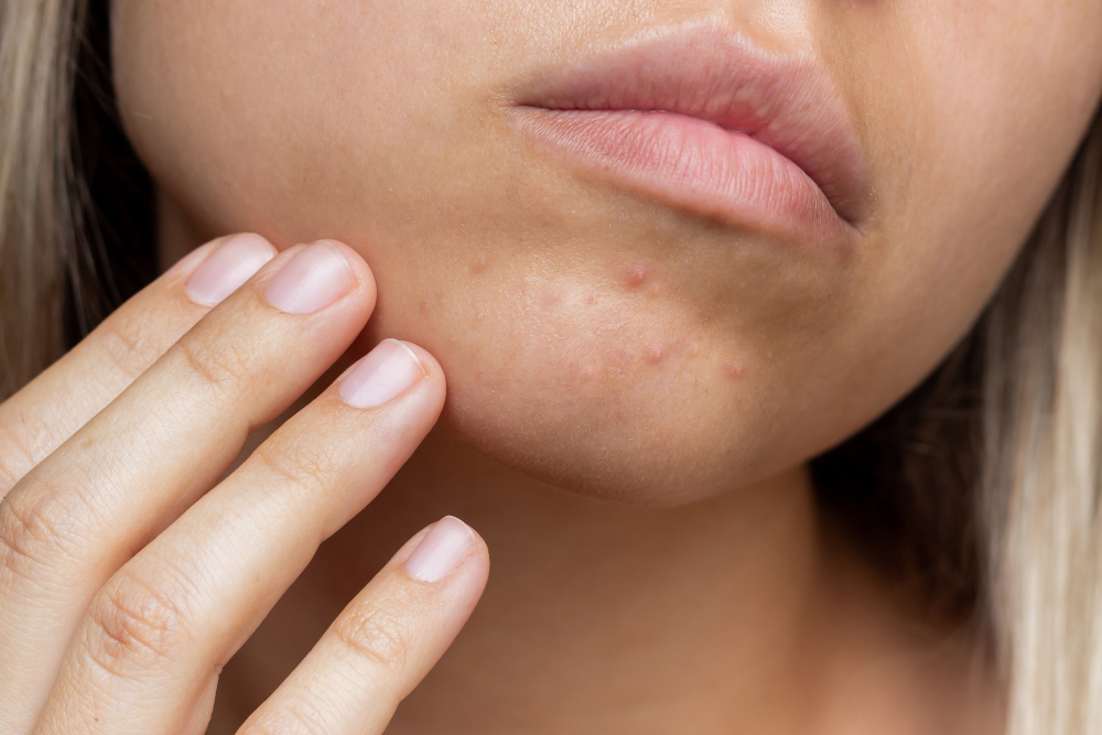 Imagem relacionada ao atendimento de acne